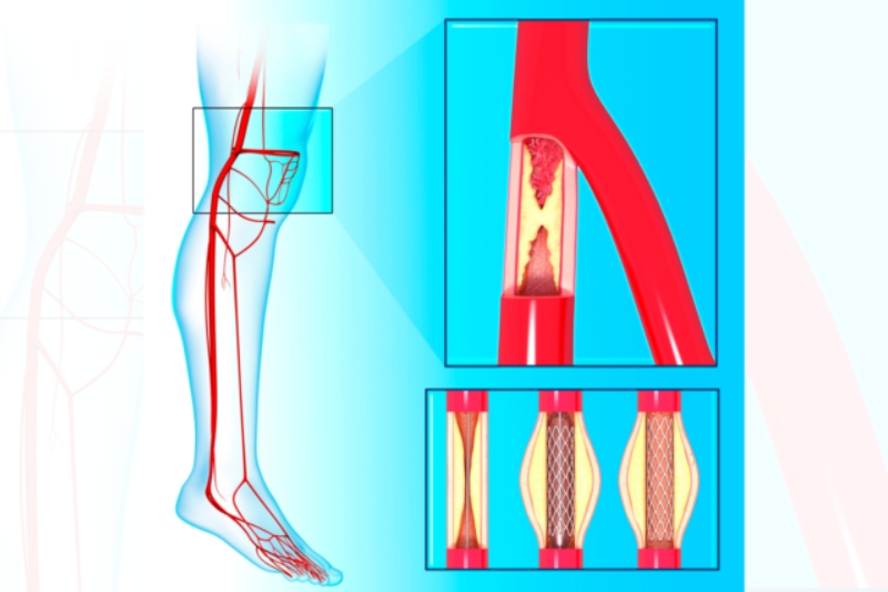 What Is Peripheral Artery Disease (PAD) and Why Early Diagnosis Matters in Flower Mound